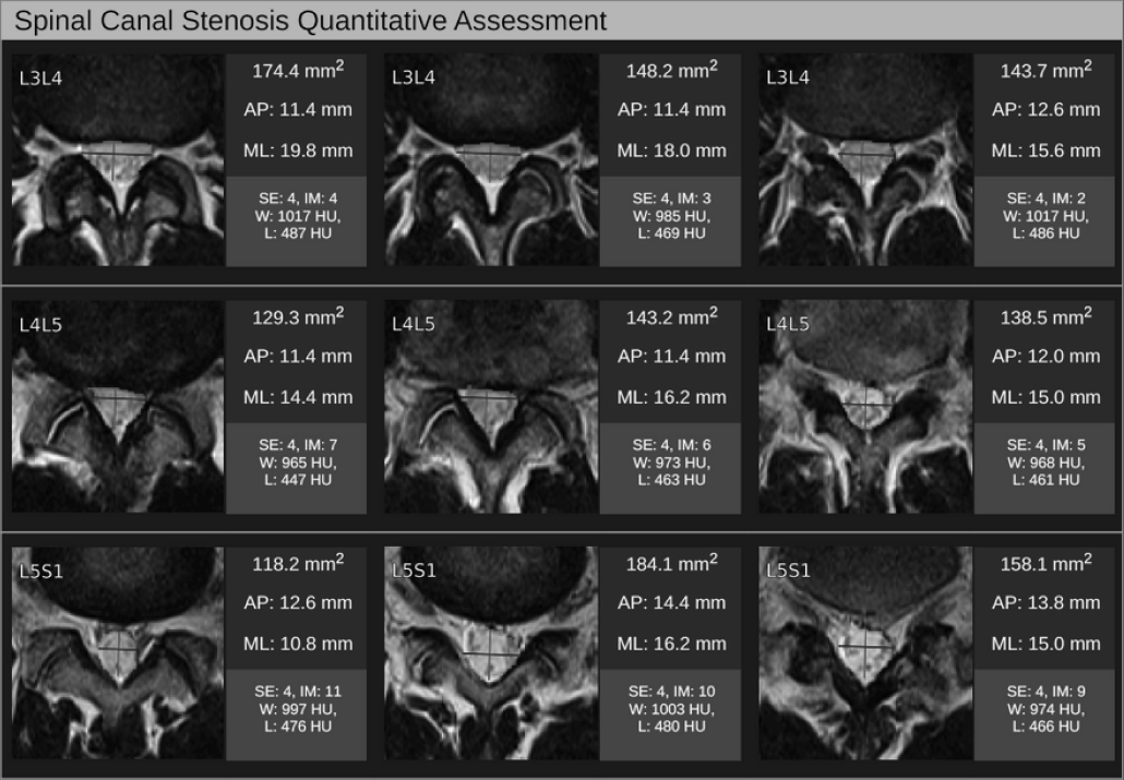 261025_Spinal Canal Stenosis