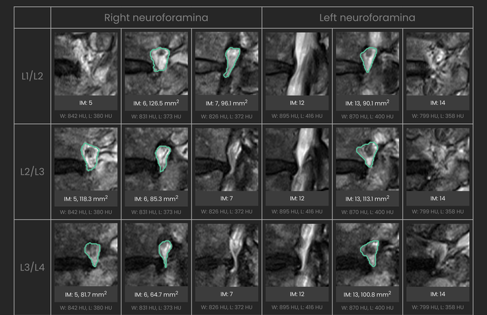 Foraminal stenosis measurements