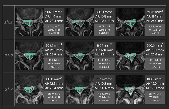 Spinal canal stenosis measurements
